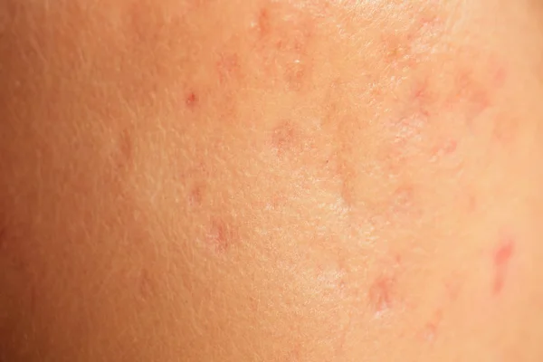 Pós-acne, cicatrizes e espinhas vermelhas na pele do rosto. conceito de problemas de pele e falha harmônica — Fotografia de Stock