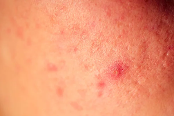 Post-acne, cicatrici e brufoli rossi sulla pelle del viso. concetto di problemi della pelle e insufficienza armonica — Foto Stock