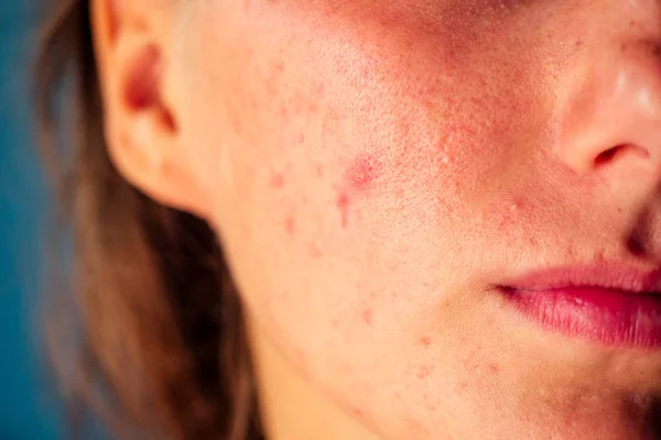 Pós-acne, cicatrizes e espinhas vermelhas no rosto de uma jovem mulher. conceito de problemas de pele e falha harmônica — Fotografia de Stock
