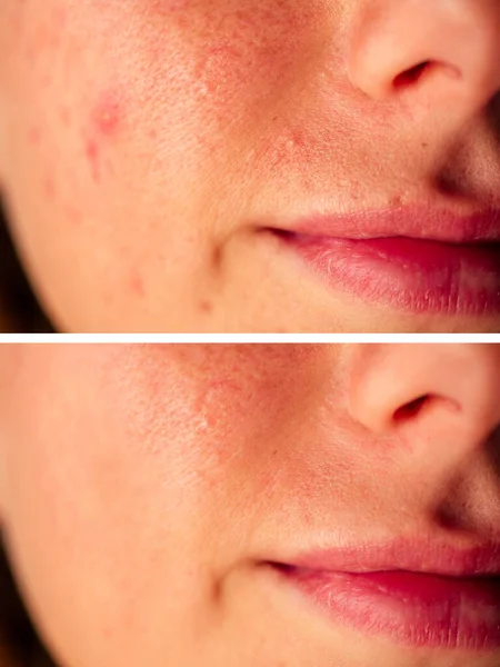Σπυράκια στο δέρμα του κοριτσιού close-up πριν από μετά — Φωτογραφία Αρχείου