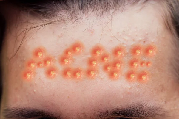 El acné de la inscripción en la piel del hombre —  Fotos de Stock