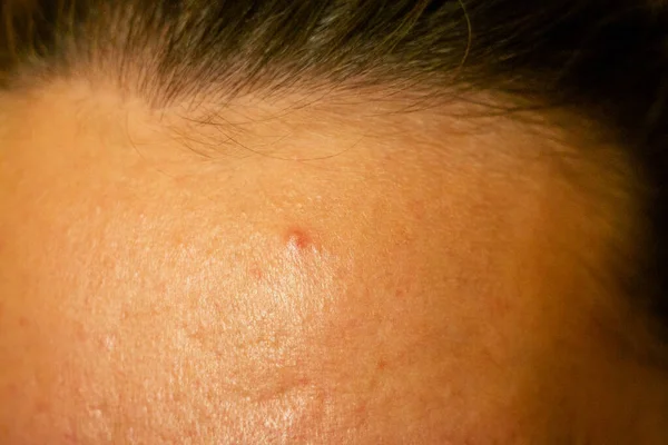 Acné, cicatrices y granos rojos supurantes en la cara de una mujer joven. concepto de problemas de la piel y fallo armónico —  Fotos de Stock