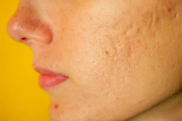 Pós-acne, cicatrizes e espinhas vermelhas no rosto de uma jovem mulher. conceito de problemas de pele e falha harmônica — Fotografia de Stock