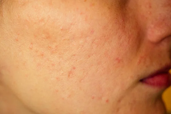 Post-acne, cicatrici e brufoli rossi sulla faccia di una giovane donna. concetto di problemi della pelle e insufficienza armonica — Foto Stock