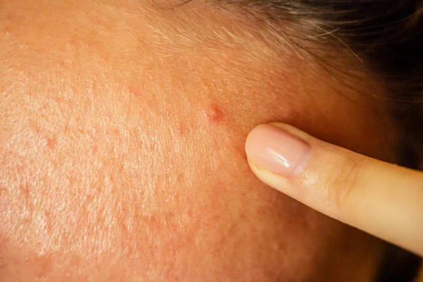 Post-acne, cicatrici e brufoli rossi sulla faccia di una giovane donna. concetto di problemi della pelle e insufficienza armonica — Foto Stock