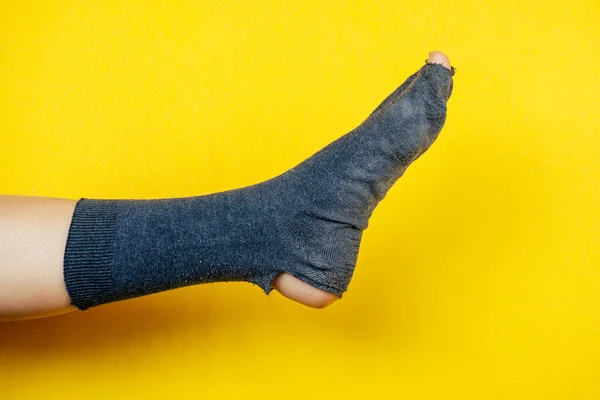 Alte stinkende Socke voller Löcher am Bein auf gelbem Hintergrund — Stockfoto