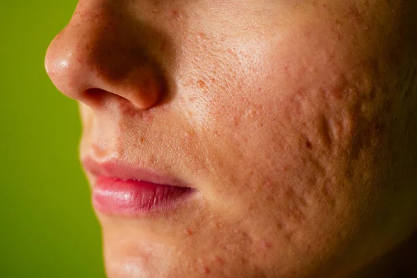 Acné, cicatrices y granos rojos supurantes en la cara de una mujer joven. concepto de problemas de la piel y fallo armónico — Foto de Stock