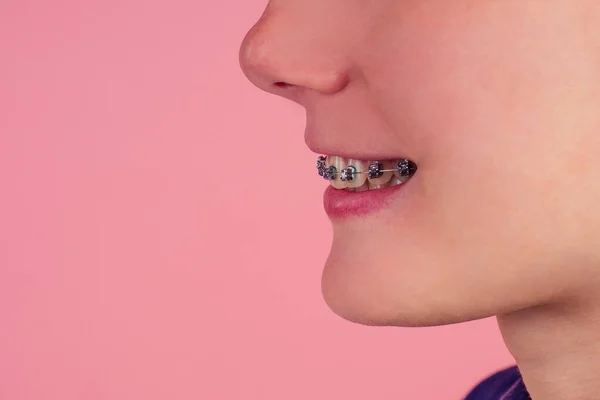 Macro shot of white teeth with braces with green color spot — Stock Photo, Image