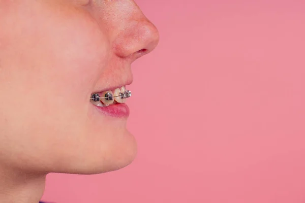 Macro colpo di denti bianchi con bretelle con macchia di colore verde — Foto Stock