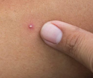 Yakın plan yüz sivilcesi.