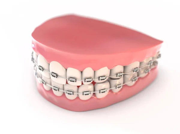 Zestaw sztucznych zębów z aparatem na zęby — Zdjęcie stockowe