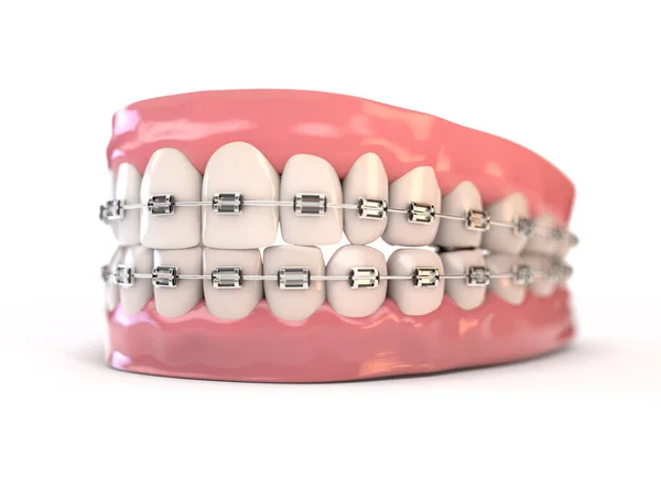 Set de dinți falși cu aparate dentare — Fotografie, imagine de stoc