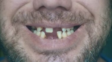 Toothless adam gülümsüyor. Orta yaşlı, aptal, dişsiz bir adam. Yaşlı adamın düşmüş dişleri