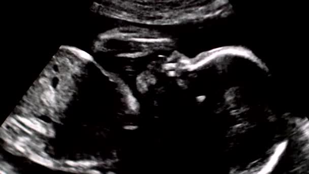 Ultrasonografie van tweede trimester zwangerschap. — Stockvideo