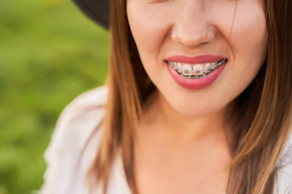 Smile not ashamed of braces, smile of a girl close-up, self-ligating braces — Stock Photo, Image