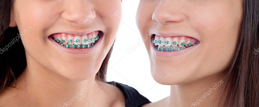 Twins sisters with brackets isolated on a white backgroung
