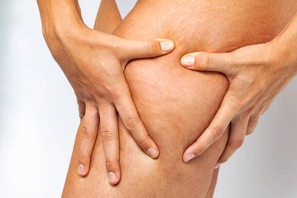 Primer Plano Las Manos Mostrando Celulitis Estrías Muslo Femenino —  Fotos de Stock