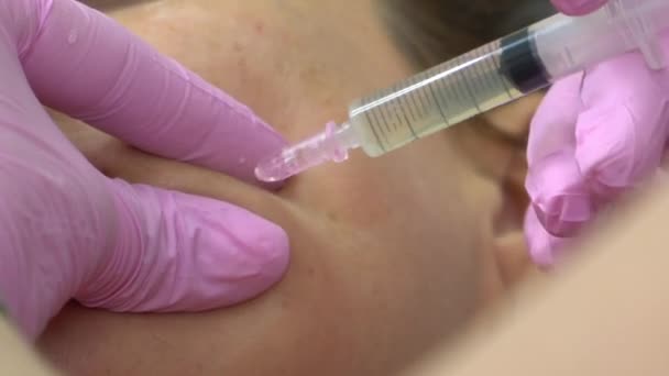 Kosmetolog Utför Flera Injektioner Området Flickans Kindben Till Patienten Botox — Stockvideo
