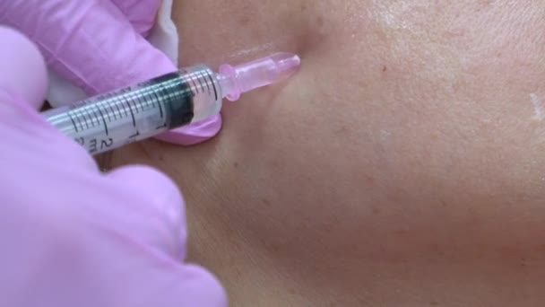 及ぼしは 患者に女の子の頬領域にいくつかの注射を行います ボトックス注射 — ストック動画