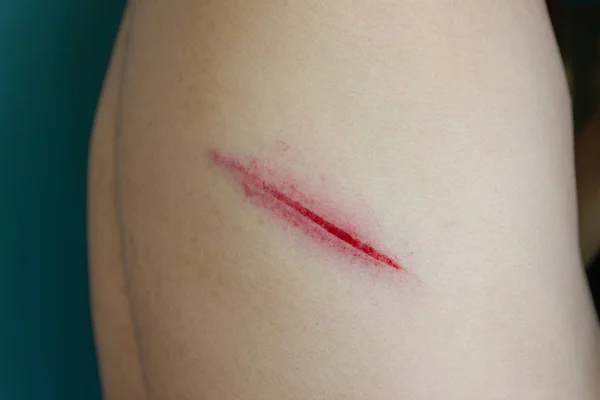 Kaza nedeniyle arkasından taze yaralar.