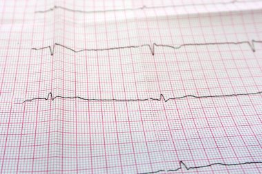 Elektrokardiyogramı kağıt formunda kapat