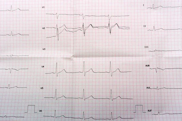 Emergency cardiology and intensive care. ECG with acute period of large-focal widespread anterior myocardial infarction