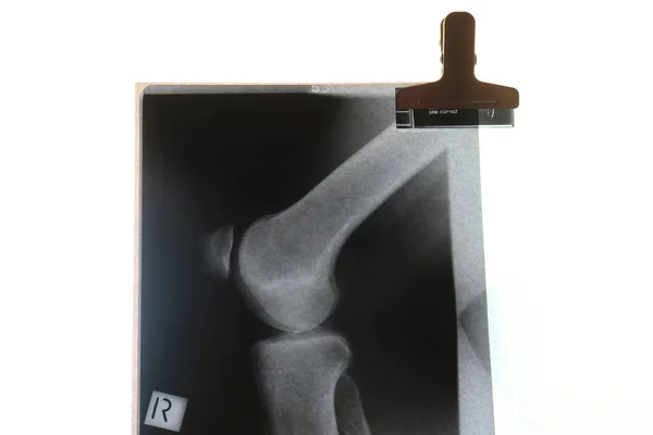 X-ray of right patella (knee) joint — Stock Photo, Image