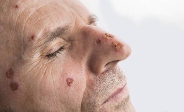 Dermatoloğun yüzündeki lazer yaraları.
