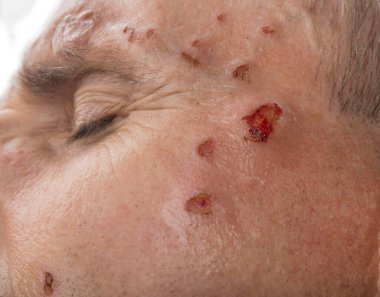 Dermatoloğun yüzündeki lazer yaraları.