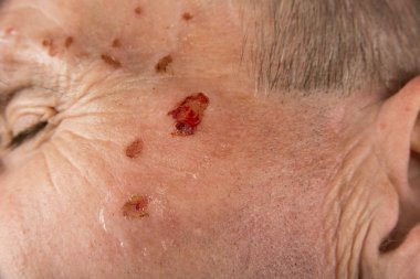 Dermatoloğun yüzündeki lazer yaraları.