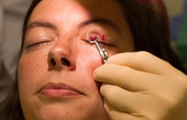 Sağlık kavramı - Chalazion sırasında göz muayenesinde ve çalışma - erkek