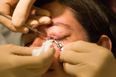 Sağlık kavramı - Chalazion sırasında göz muayenesinde ve çalışma - erkek