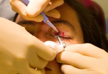 Sağlık kavramı - Chalazion sırasında göz muayenesinde ve çalışma - erkek