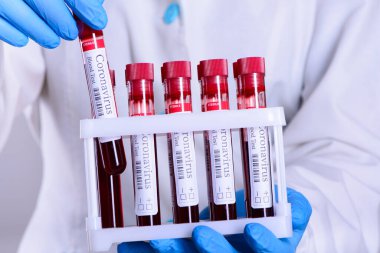KOVID-19 test ve teşhis koronavirüs enfeksiyonu için yapılan kan testinin laboratuvar numunesi beyaz arka planda ve reklam konsepti için izole edilmiş laboratuvar asistanının ellerinde.