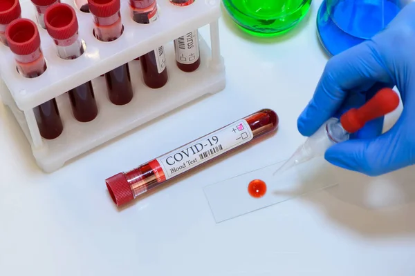 Тест Covid Лабораторний Зразок Аналізу Крові Діагностики Коронавірусної Інфекції Руках — стокове фото