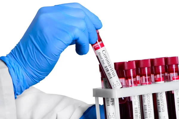 Covid Test Laboratory Sample Blood Testing Diagnosis Coronavirus Infection Hands — Stock Photo, Image