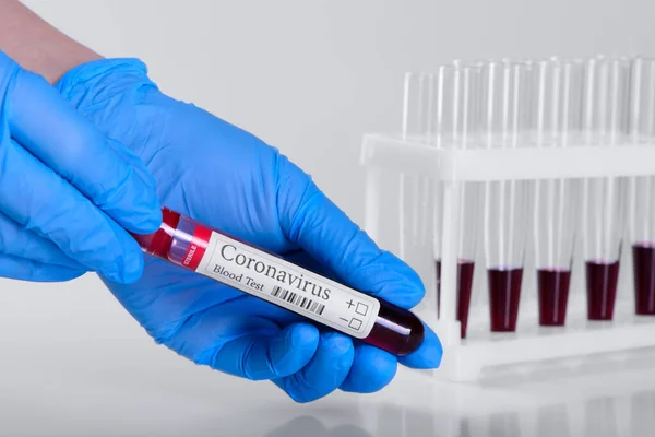 Тест Covid Лабораторний Зразок Аналізу Крові Діагностики Коронавірусної Інфекції Руках — стокове фото
