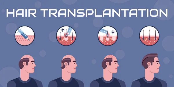 Hair transplantation steps — Stock Vector