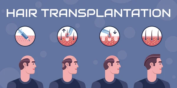 Pasos de trasplante de cabello — Vector de stock