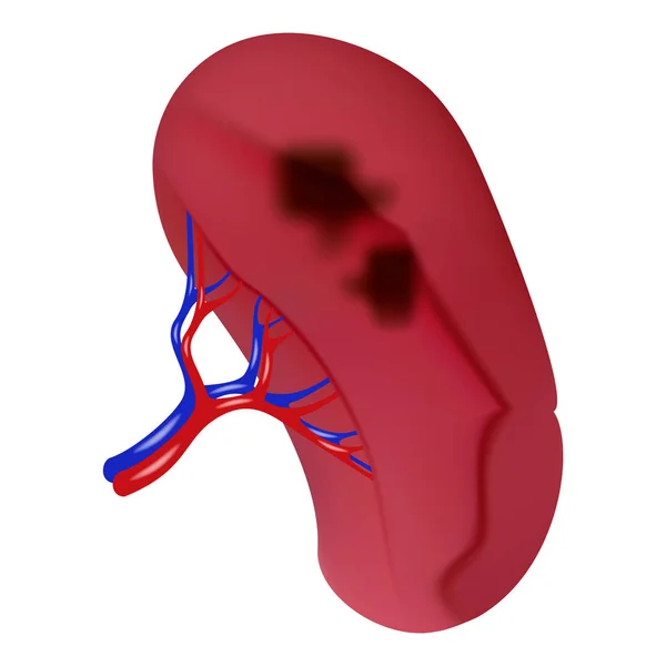 Malattia nera dell'icona della milza, stile realistico — Vettoriale Stock