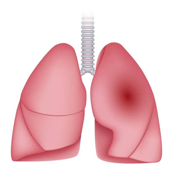 Neumonía enfermedad pulmonar icono, estilo realista — Vector de stock