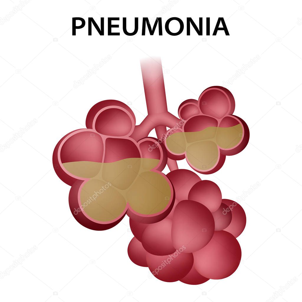 Pneumonia alveoli icon, realistic style