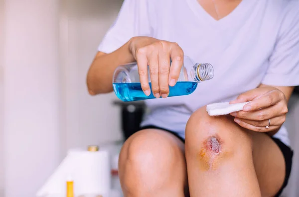 Mujer Vertiendo Alcohol Algodón Para Limpiar Herida Sangrante Rodilla Costra — Foto de Stock