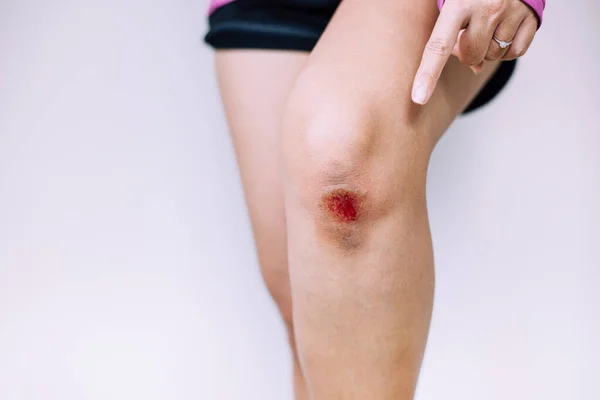 Frau Zeigt Blutende Wunde Knie Auf Weißem Schwarzgrund Schorf Infiziert — Stockfoto