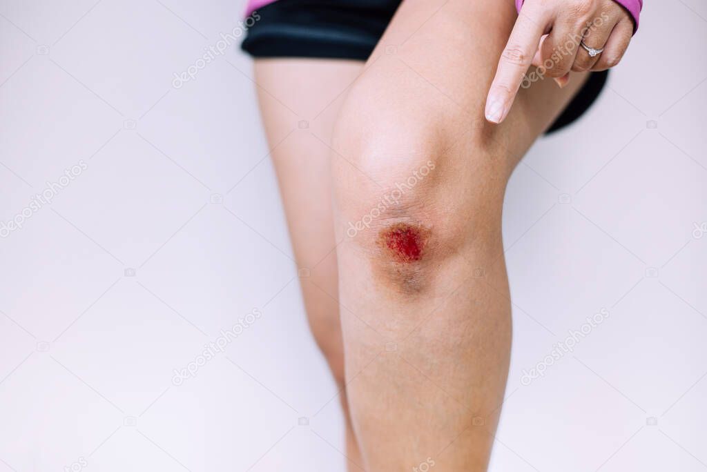 Woman showing bleeding wound on knee on white blackground,Scab becomes Infected