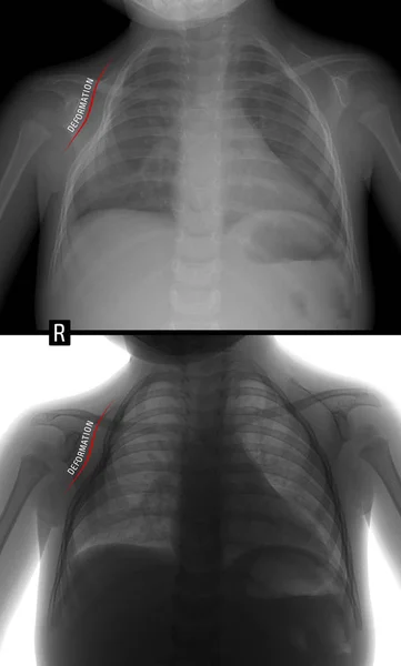 Ray Πνεύμονες Παραμόρφωση Του Θώρακα Στα Δεξιά Παιδί Αρνητική Θετικό — Φωτογραφία Αρχείου