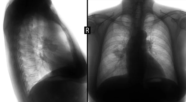 Pulmones Rayos Cáncer Central Del Pulmón Derecho Negativo — Foto de Stock