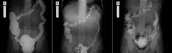 X-ray of the lower parts of the gastrointestinal tract (GI). Tight filling. Emptying. Insufflation by air. Diverticulosis.