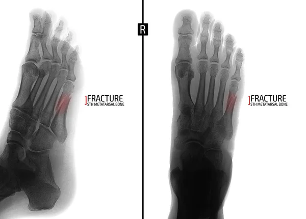 Рентгеновская Нога Перелом Пятой Плюсневой Кости Маркер Отрицательно — стоковое фото
