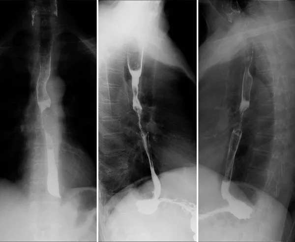 X-ray of the upper gastrointestinal series (UGI) with barium. Cancer of the esophagus. Radiology of the upper gastrointestinal series (UGI) with barium. Cancer of the esophagus.